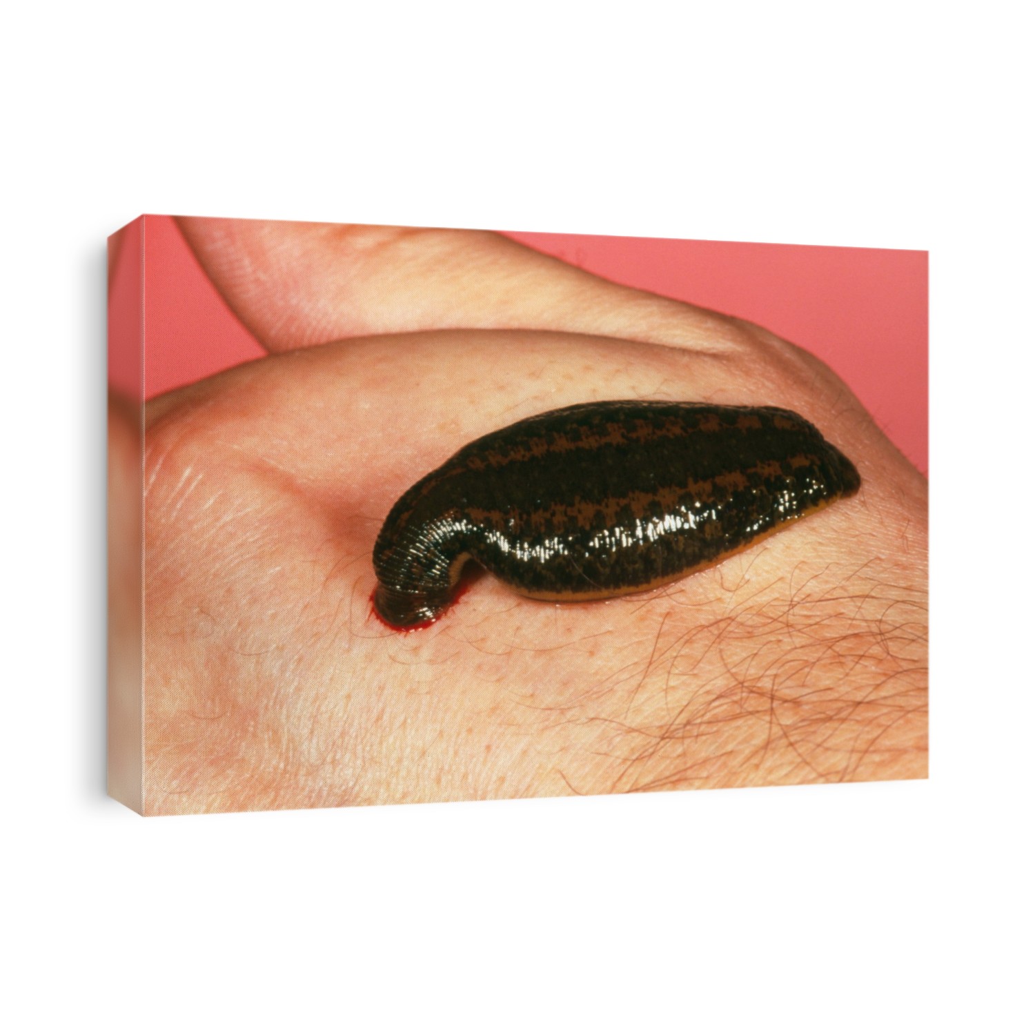 Leech. Medicinal leech (Hirudo medicinalis) feeding on a human hand. Leeches are parasites which feed on blood. They attach themselves to the skin using suckers and create a wound with their three sharp jaw plates. Their saliva contains hirudin, a chemical which prevents the blood from clotting. They are used in modern medicine to drain blood from haematomas (accumulations of blood) and to draw blood into transplanted tissues until circulation is established. A leech may drink between 10 and 15 millilitres of blood in one meal, which will feed it for months.